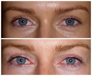 Eyeliner Cosmetic Tattoo Sydney