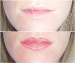 lips tattooing Bondi Junction Sydney